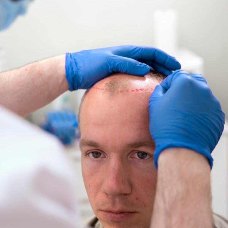DHI-Haartransplantation